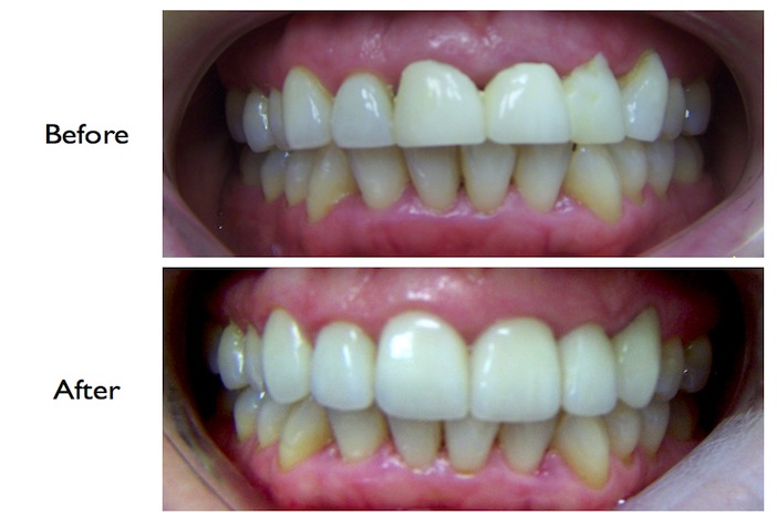 Pictures of a smile enhancement by crowns and veneers done at our Finchley Road, NW3 dental practice