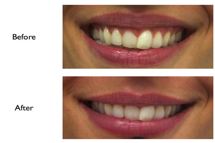 Pictures of a gummy smile correction using Botox performed at our Finchley Road, NW3 Dental Practice