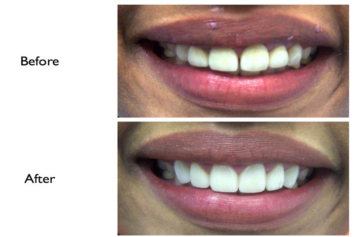 Smile enhancement by gum conturing, veneers & crowns performed at our Finchley Rd NW3 Dental Clinic