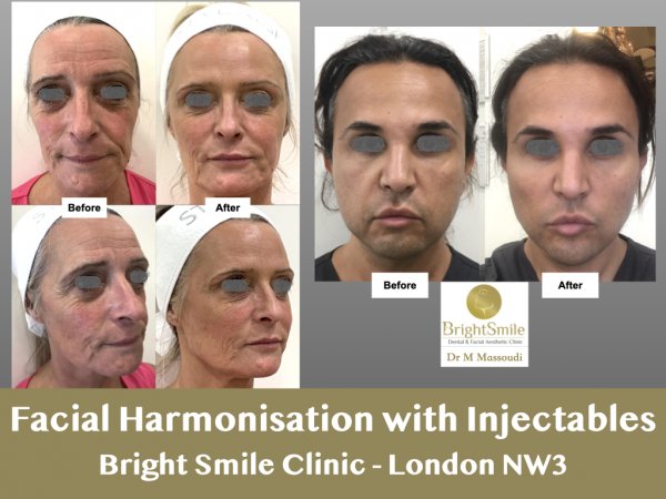 facial harmonization_march 2023