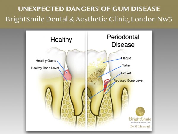 gum disease March 2019