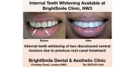 Internal Whitening Of Non-vital Teeth Available At BrightSmile Dental & Aesthetic Clinic NW3
