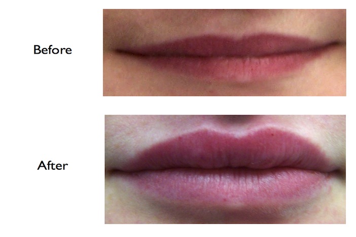 Lip Enhancement using Juvederm (dermal filler) done at our NW3/Finchley Road dental practice
