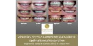 Zirconia Crowns: A Comprehensive Guide to Optimal Dental Restoration, available at Bright Smile Clinic, London NW3