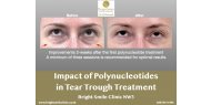 Impact of Polynucleotides in Tear Trough Treatment - Bright Smile Clinic, London NW3