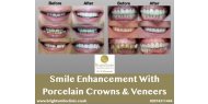 Smile Enhancement Treatments Available at Bright Smile Dental & Aesthetic Clinic London NW3