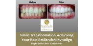 Smile Transformation: Achieving Your Best Smile with Invisalign - Bright Smile Clinic - London NW3