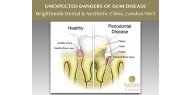 The unexpected dangers of gum disease